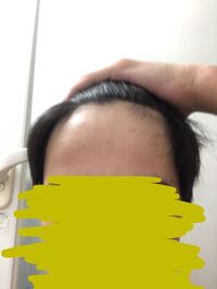 中1男子です 何故がまえがが全然伸びなくて前髪上げてみたらおでこが広く Yahoo Beauty