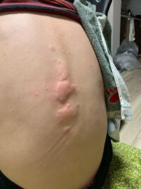 質問です 彼氏とケンカをすると 彼氏の背中に蕁麻疹が出ます これはス Yahoo 知恵袋