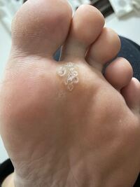 最近足の裏にボコっとした硬い何かができました そんなに痛く Yahoo 知恵袋