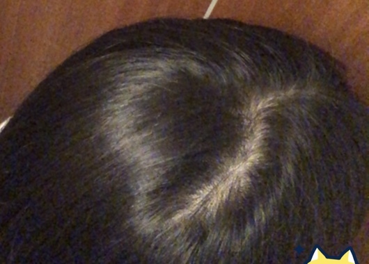 質問は ヘアリセッターを続けるとひどいつむじ割れもなくなるのか です まず Yahoo 知恵袋