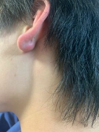 腫れる 耳たぶ