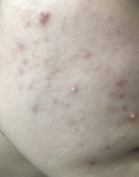 汚い写真失礼します 思春期ニキビに悩んでいます 私は赤ニキビ白ニ Yahoo 知恵袋