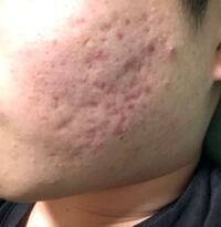 これってニキビ跡ですか ニキビ跡って皮膚科行っても意味ない Yahoo 知恵袋