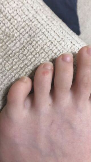 コロナの症状で 足の指に赤い斑点ができると聞いたのですが 私の足 Yahoo 知恵袋