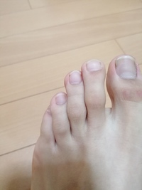 心配です 私の足の小指が曲がってるような気がします 両方の足です Yahoo 知恵袋