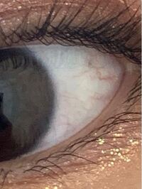 目の充血が酷いです なにか対策や治す方法を教えてください Yahoo 知恵袋