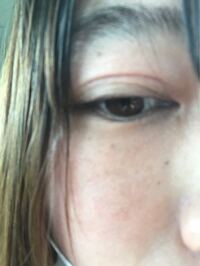 今年2 10に ある美容外科で二重全切開目頭切開 目尻切開をおこないました Yahoo 知恵袋