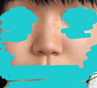 これって豚鼻ですか 低い潰れてる上向きの鼻がコンプレックスで Yahoo 知恵袋