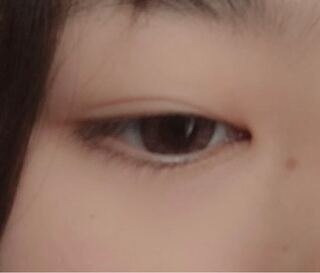朝起きたら左目の目頭の上まぶたの方が腫れてました 痛みはないです これは市 Yahoo 知恵袋