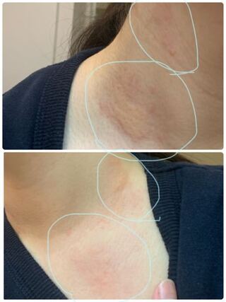虫刺され 腫れ 大きい