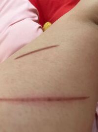 ヘアアイロンで4日前二の腕を火傷してしまいました涙 なかなか良くならず 跡 Yahoo 知恵袋