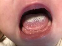 新生児の時から 舌に黒い異物がついてることがあります これはなんですか Yahoo 知恵袋