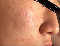 目の下が 毛穴というより凸のようになっています またそこがクマのように黒く見え Yahoo 知恵袋