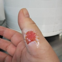 潰れ た 水ぶくれ
