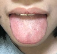 する ヒリヒリ 病気 が 舌 ３月頃から舌がヒリヒリする。