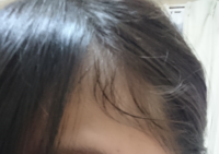 前髪の横 の生え際のくせ毛をどうにかしたいです 汚い写真ですみません Yahoo Beauty