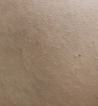 背中のザラザラの改善方法10代の女です 背中のザラザラに悩んでいます めち Yahoo 知恵袋