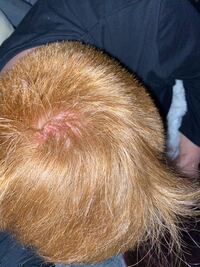 果たしてこれはつむじハゲですか つむじが赤く腫れているのは Yahoo 知恵袋