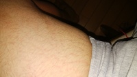 僕は、中3男子です。
ラグビーと柔道をやってます。
太ももに画像のような肉割れがあります。実際はもっとひどいです。股のギリギリまで来るともっとひどいです。
これは、太ももが太い人は 仕方ないんですか？