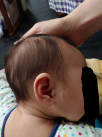 おでこの形7か月男の子おでこの出っ張りが気になります頭蓋骨縫合早期癒合 Yahoo 知恵袋