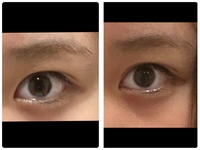 ものもらいになり アイプチで作った二重幅のような違和感のある二重幅 Yahoo 知恵袋