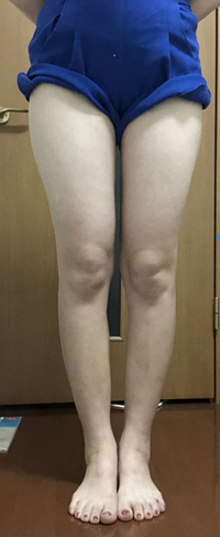 私は 外ももがすごく太いです 内股で歩くのも関係してると思いますが ダイエ Yahoo 知恵袋
