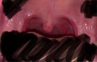 喉の写真あり 閲覧注意です 喉ちんこ 口蓋垂 に赤い斑点があるのです Yahoo 知恵袋