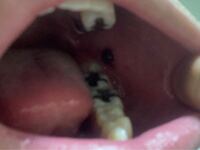 写真のような黒い口内炎のようなものが 出来ました 上下奥歯 Yahoo 知恵袋