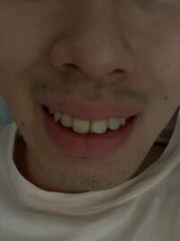 歯列矯正について 本気で悩んでます 先ず 汚い画像ですみま Yahoo 知恵袋