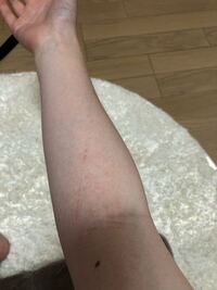 数週間前から腕に内出血のような斑点ができていて 少し薄くな Yahoo 知恵袋
