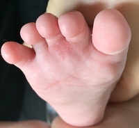 赤ちゃんの足の指の付け根に小さな水疱みたいなものが生後3ヶ月の娘なのですが Yahoo 知恵袋