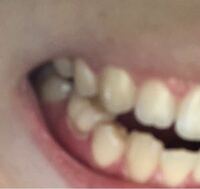 歯茎についてです 写真のように歯茎の根本が白くなっていて 全体的 Yahoo 知恵袋