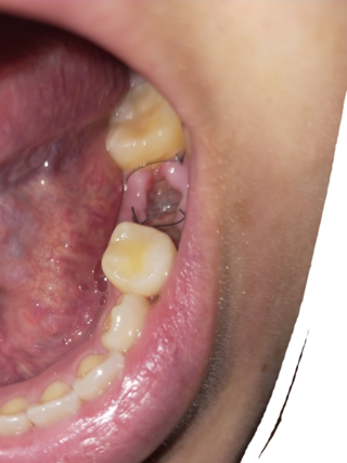 閲覧注意 ドライソケットでしょうか ４日前に抜歯しましたが Yahoo 知恵袋