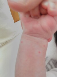 あかちゃん赤い斑点について3ヶ月の赤ちゃんなんですが 手と太ももに赤い Yahoo 知恵袋