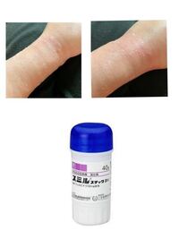 腱鞘炎で2日前くらいに整形外科に行き スミルスチックを処方してもらっ Yahoo 知恵袋