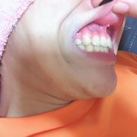 歯列矯正4年の抜歯2本でこれはやばくないですか 正直言って Yahoo 知恵袋