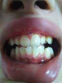 写真あり 中学生で もしかしたら歯周病かもしれないです 歯茎が Yahoo 知恵袋