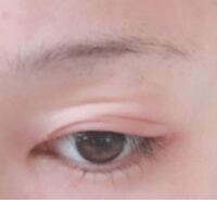 汚くてすみません つい最近d Upのつけまのりでかぶれまし Yahoo 知恵袋