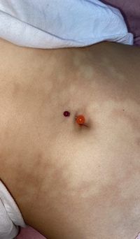 いつのまにかシミのような斑点が 中学生か高校生くらいから身体中に Yahoo 知恵袋