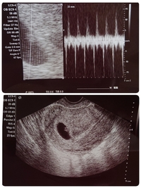 妊娠6週と4日のエコー画像です 初診での時のものですが 胎嚢 胎 Yahoo 知恵袋