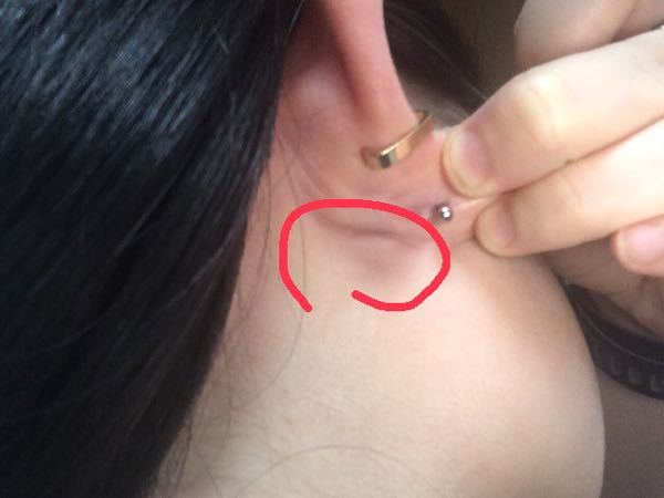 耳の後ろにしこりができたみたいです 病院行った方がいいですか Yahoo 知恵袋