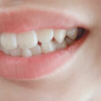 画像の歯は八重歯と言えますか また この歯は普通の歯と比べ Yahoo 知恵袋