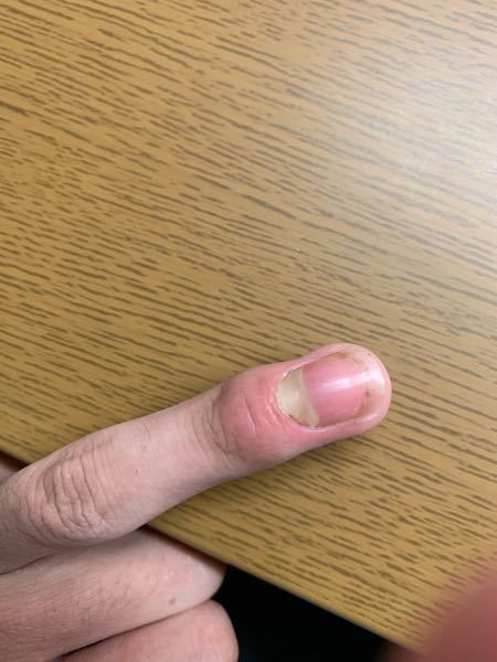 ひょうそになってしまって 指がすごく晴れてましたが テラマイシン Yahoo 知恵袋