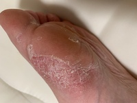 水虫が酷いです 市販の薬を塗ったら酷くなりました 夜になるとすご Yahoo 知恵袋