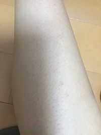 ここまでひどくなった 足の毛穴はどうやってケアしたらいいでしょうか Yahoo 知恵袋