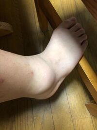 捻挫について質問です 二週間前に外を走っていて足をひねりました二週間経 Yahoo 知恵袋