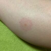 高2です昨日虫刺されにムヒパッチを貼ったら 貼った部分が赤くなってしまいま Yahoo 知恵袋