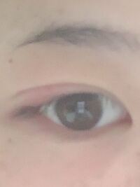 これは ものもらいですか 先週 埋没法をして腫れが引いて4日目くら Yahoo 知恵袋