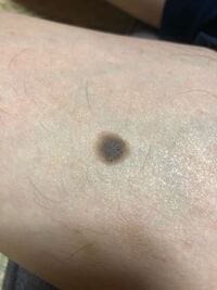 これはメラノーマ 悪性黒色腫 でしょうか 父の太ももにあり Yahoo 知恵袋