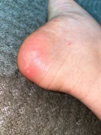 かかとにこんなぶつぶつが出来てとても痒いです これはなんですかね Yahoo 知恵袋